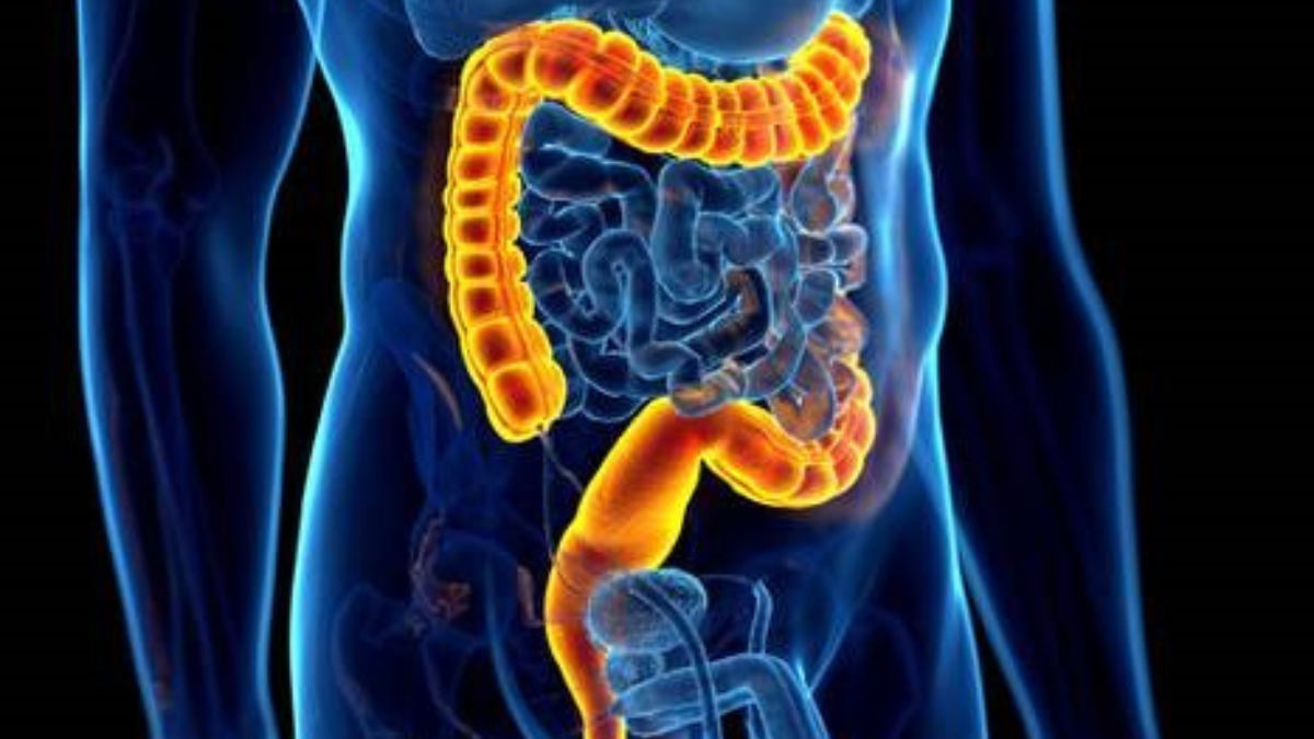 Diverticulite: características da doença, tratamento e prevenção.