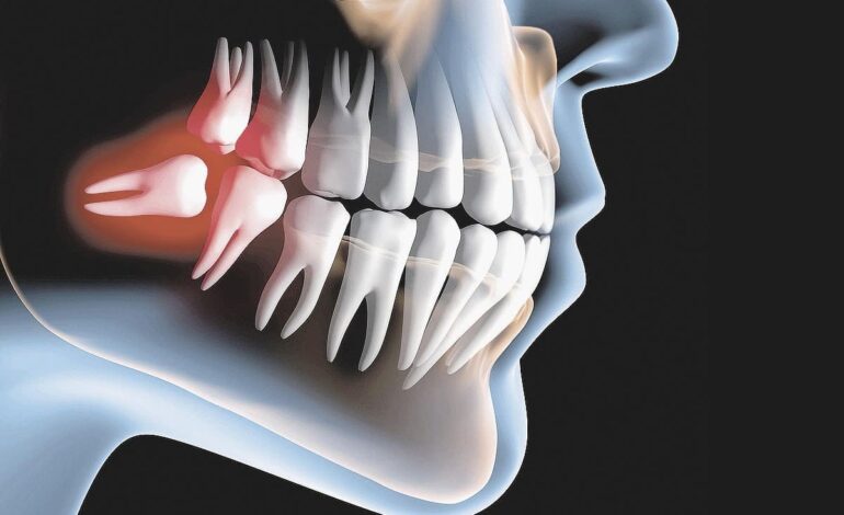 Dentes do siso guardam células-tronco capazes de formar neurônios e regenerar tecidos