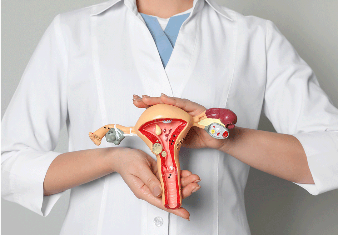 Tumores ginecológicos: tipos, sinais de alerta e estratégias de prevenção