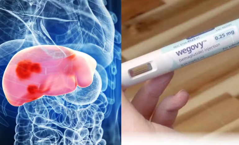 Anvisa autoriza uso do Wegovy no tratamento da gordura no fígado com inflamação