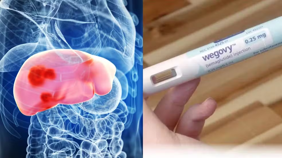 Anvisa autoriza uso do Wegovy no tratamento da gordura no fígado com inflamação