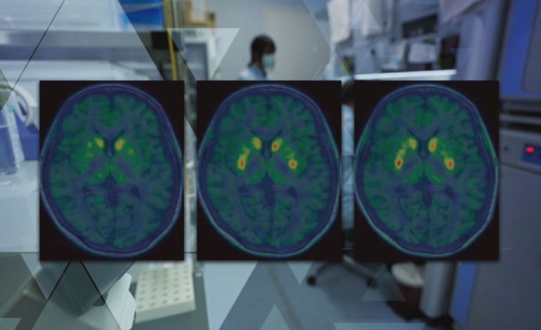 Terapia celular para Parkinson avança e tenta restaurar dopamina no cérebro: uma nova fronteira na medicina regenerativa