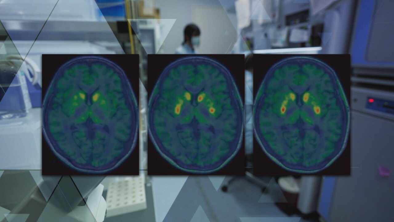 Terapia celular para Parkinson avança e tenta restaurar dopamina no cérebro: uma nova fronteira na medicina regenerativa